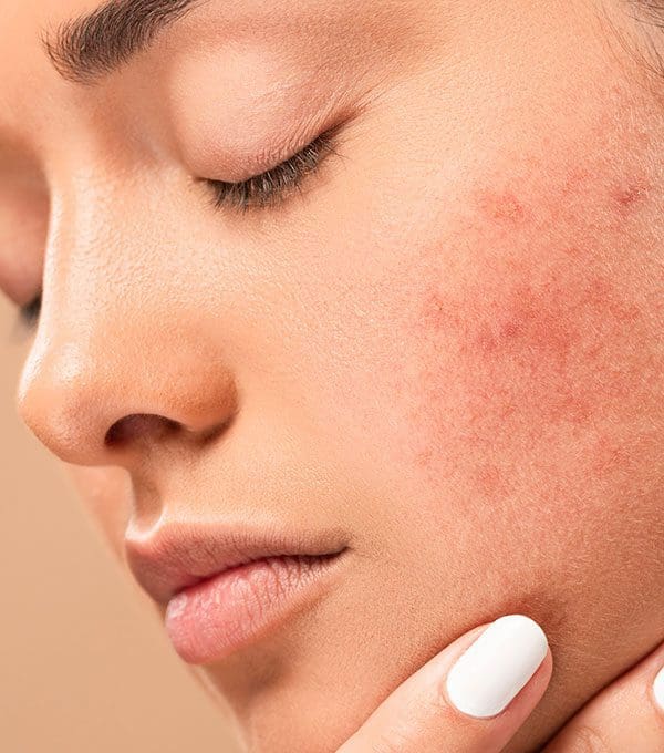 prix roaccutane