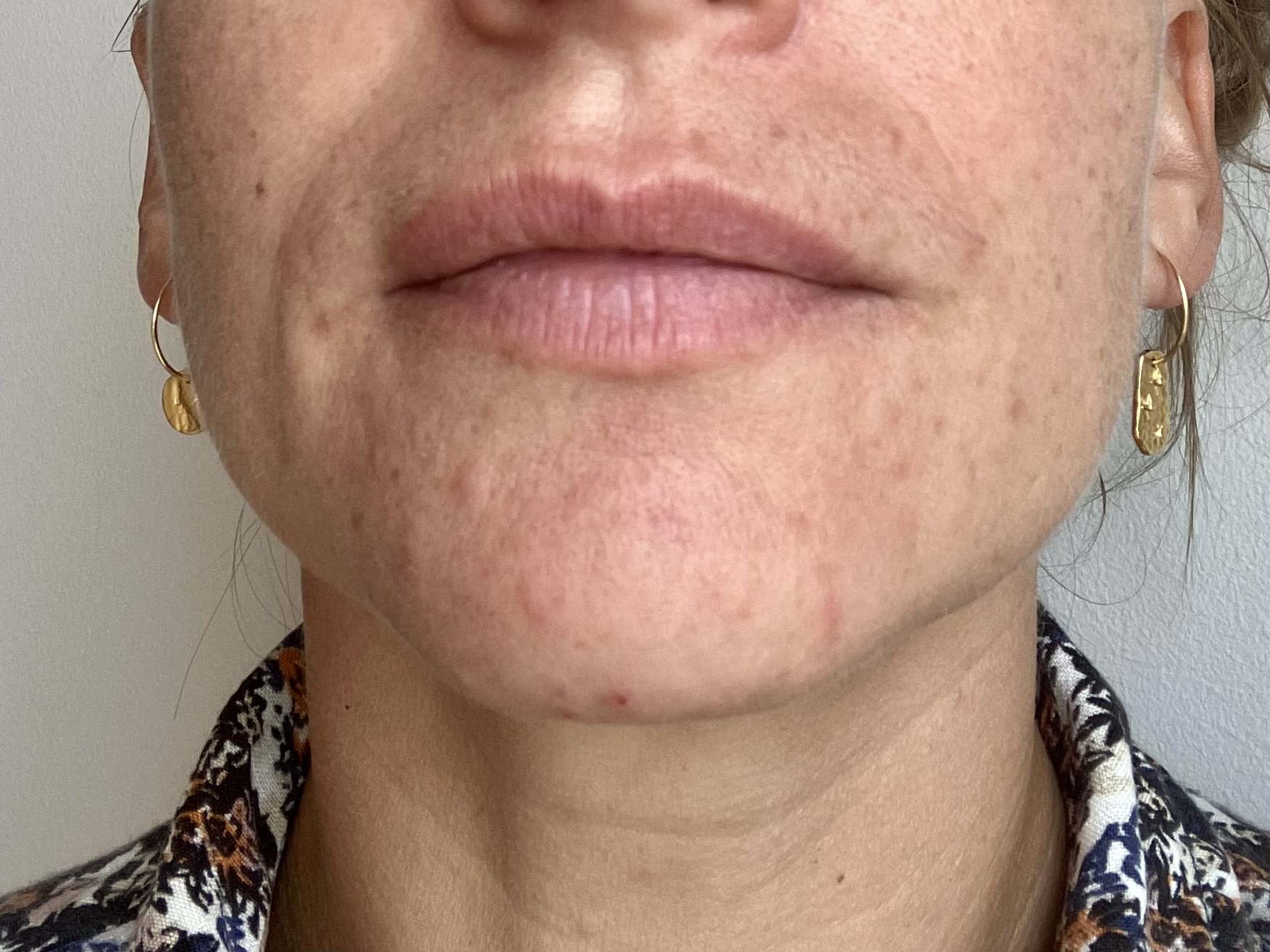 Roaccutane Prix Remboursement