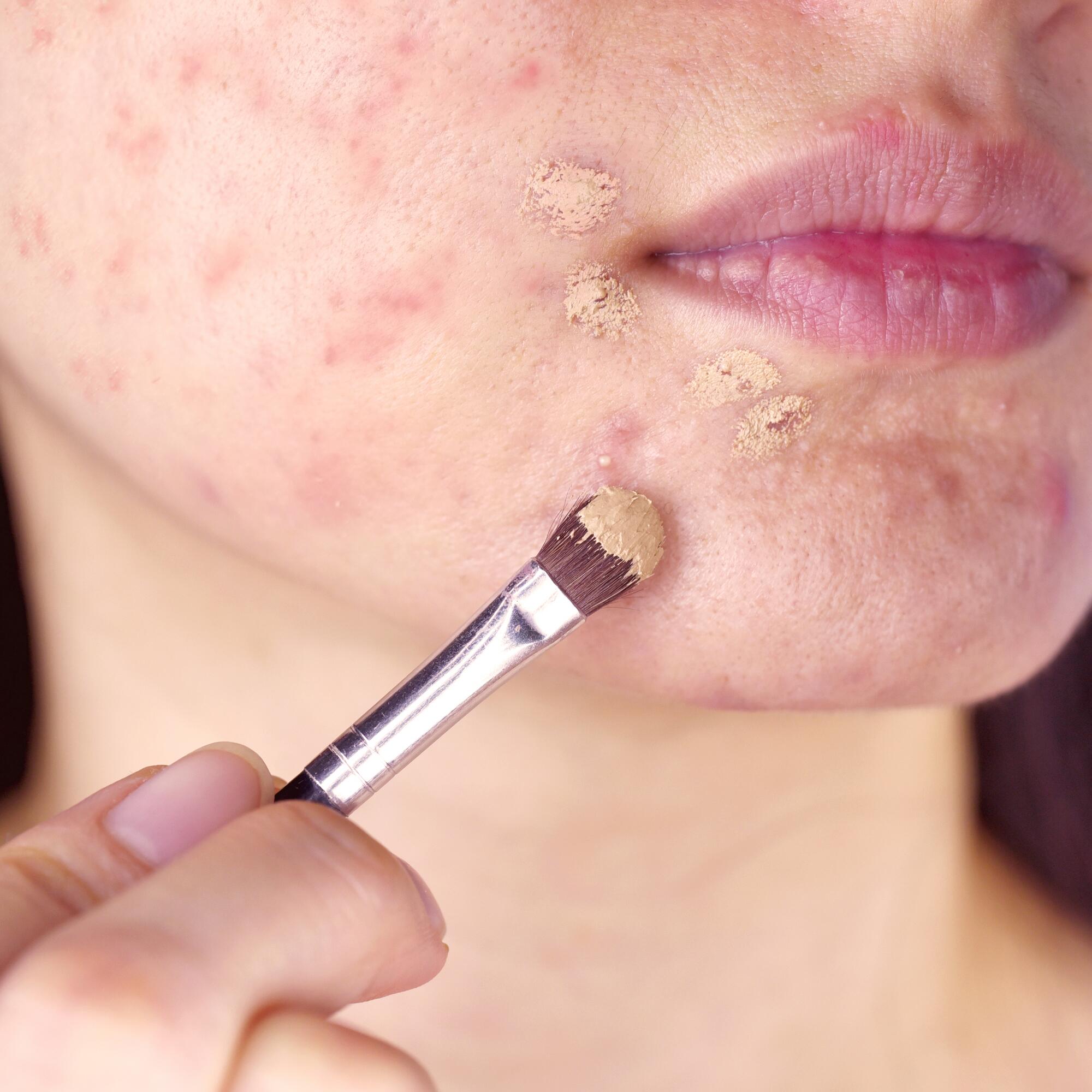 roaccutane en ligne