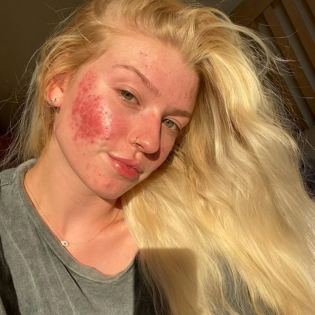 Roaccutane gel prix remboursement