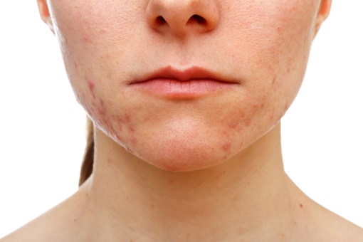 Où acheter du roaccutane