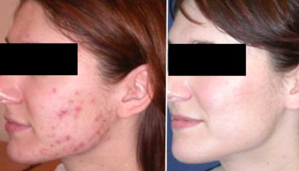 Roaccutane acné pilule