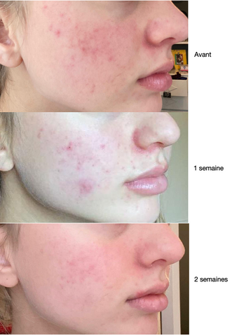 Prix roaccutane france