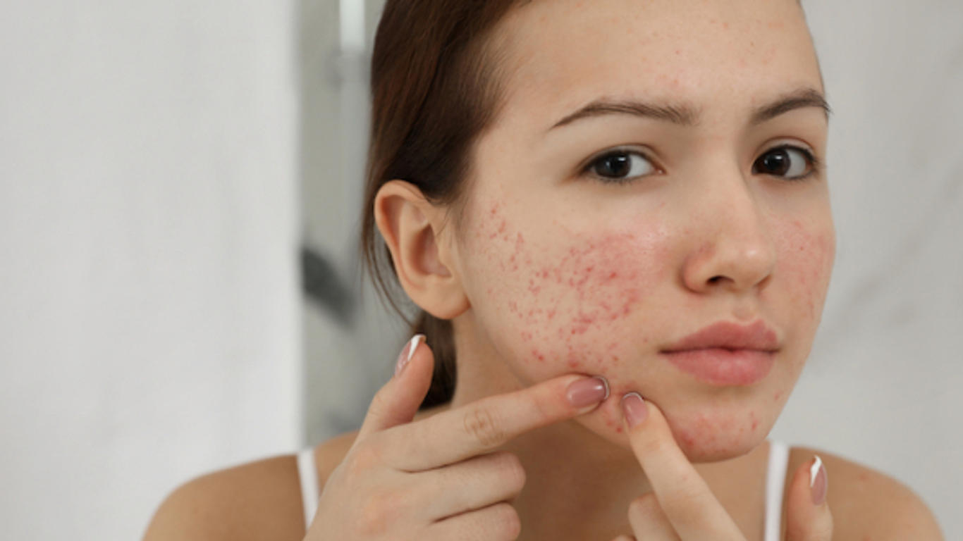 Roaccutane ou pilule