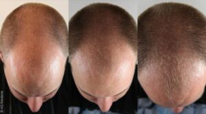Finasteride gel prix
