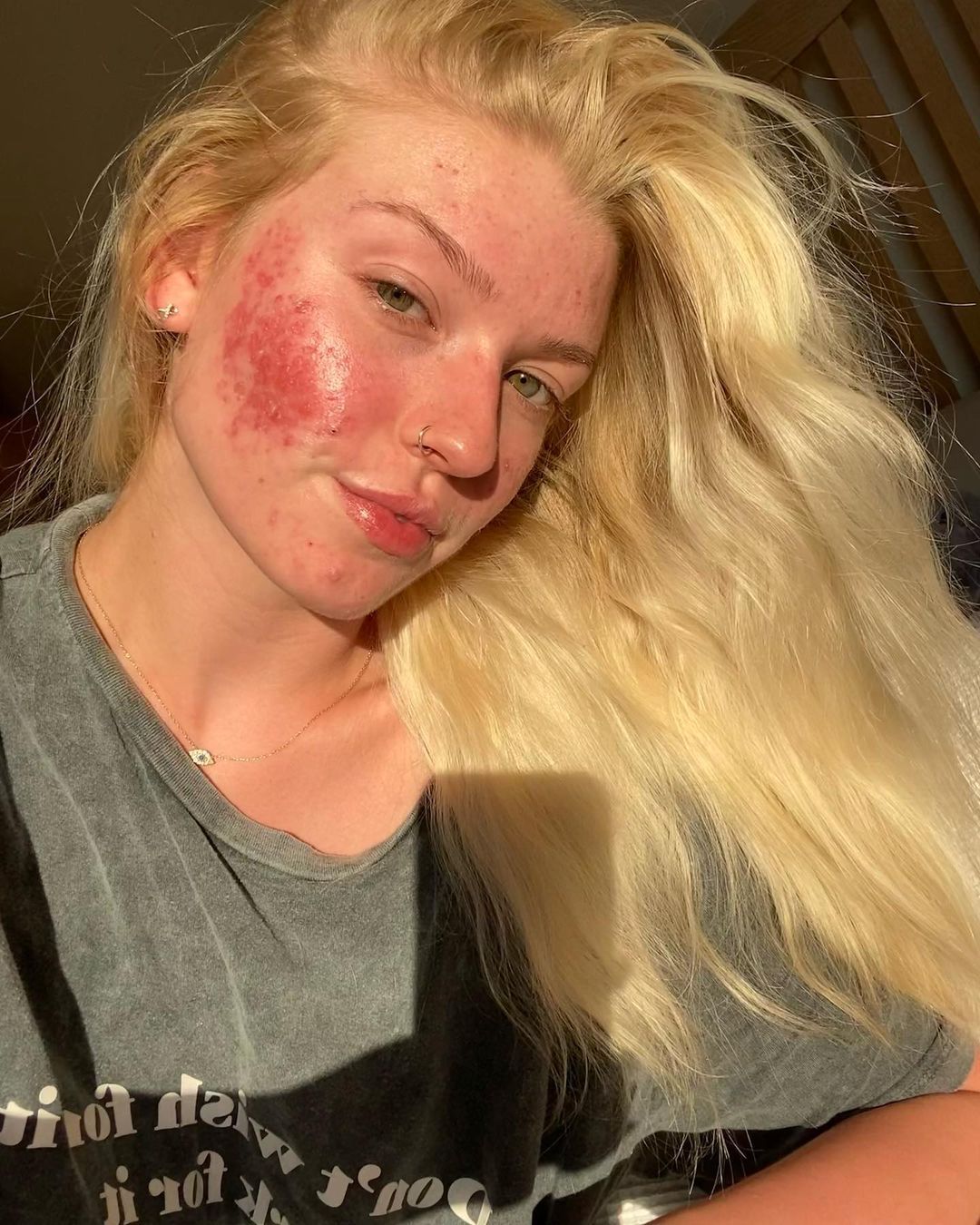 Prix du roaccutane