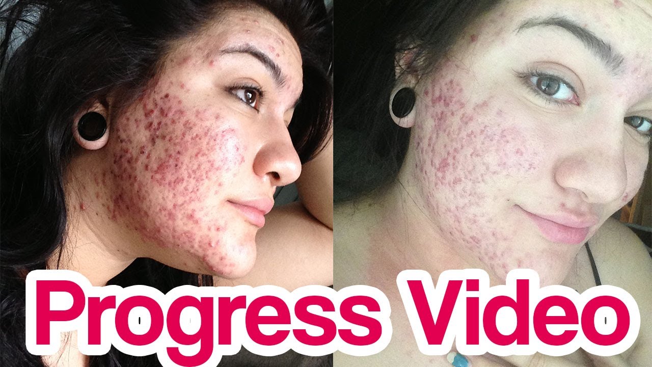 Accutane 10mg