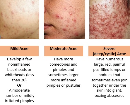 Roaccutane prix acné