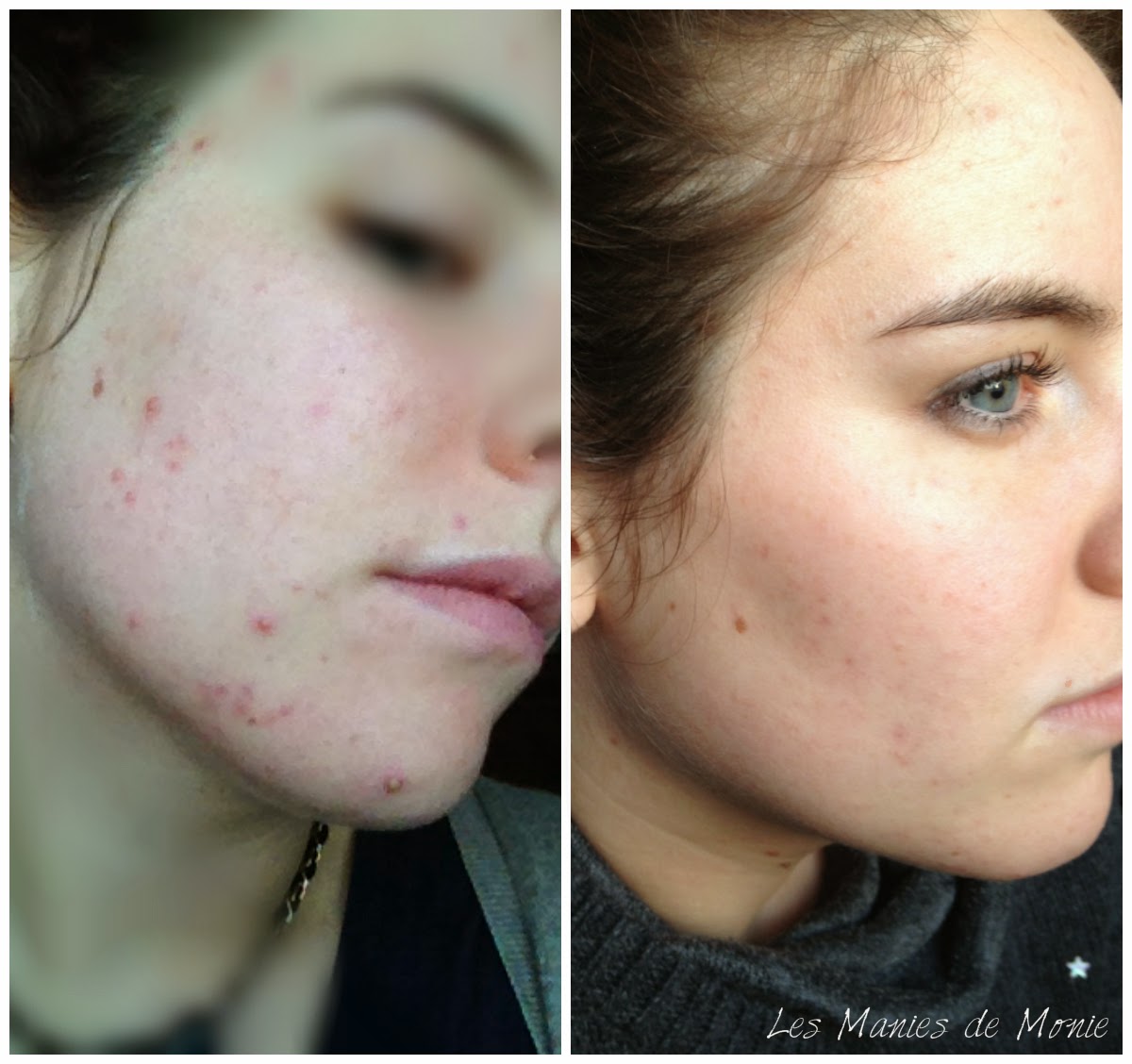 Roaccutane apres arret pilule