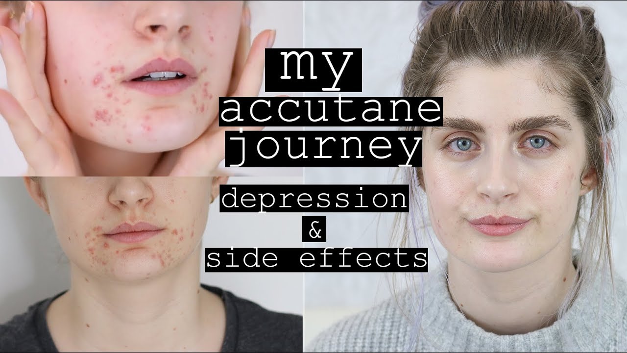 Accutane 30mg