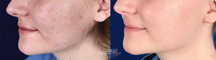 isotretinoin online acheter