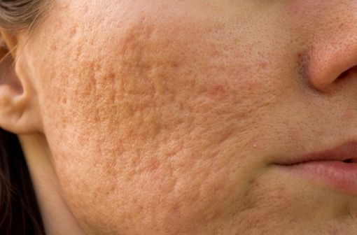 Commander Roaccutane En Ligne