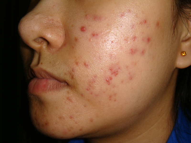 Isotretinoin online acheter