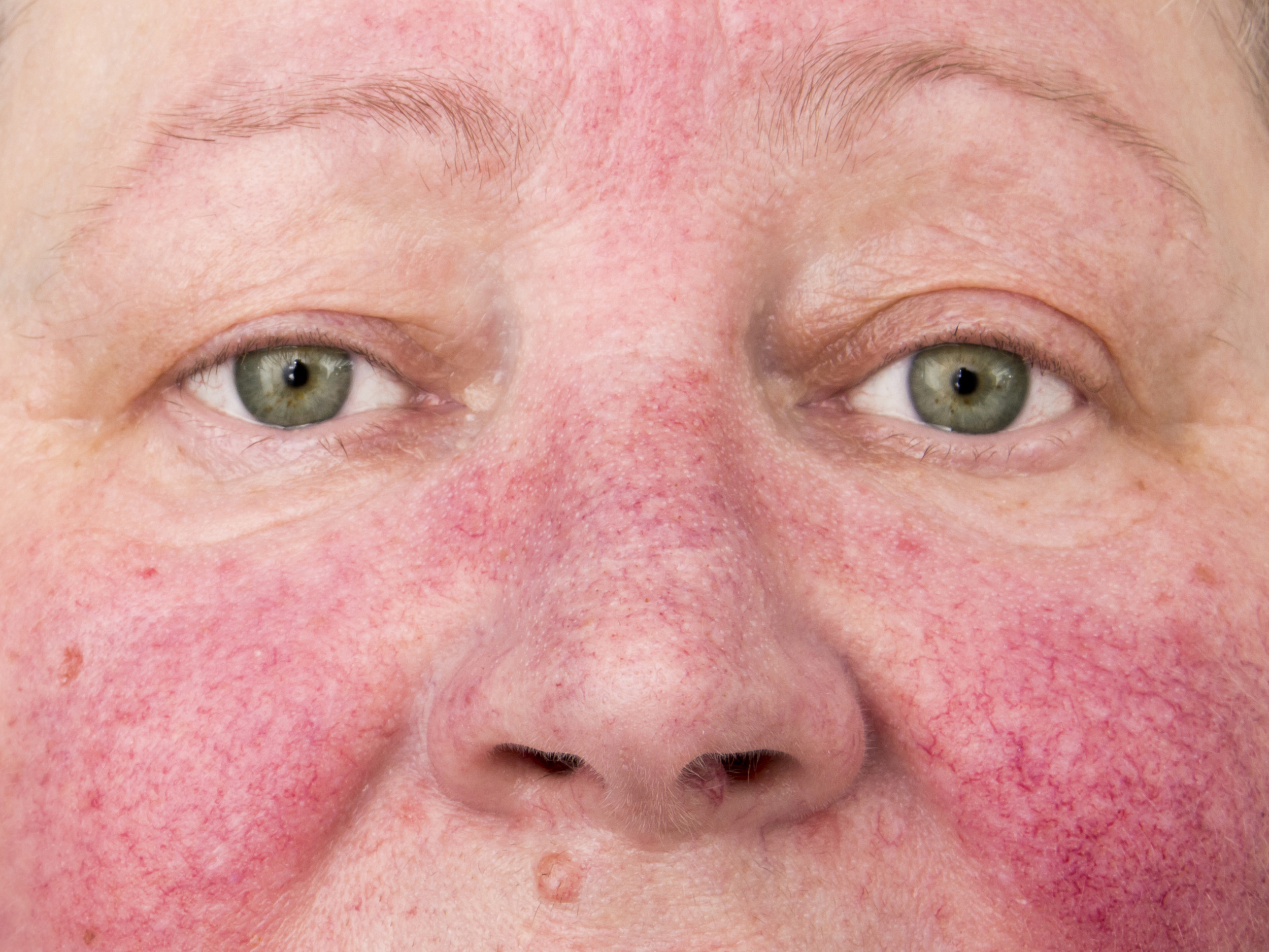 Roaccutane compra online