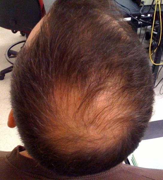 Finasteride gel france
