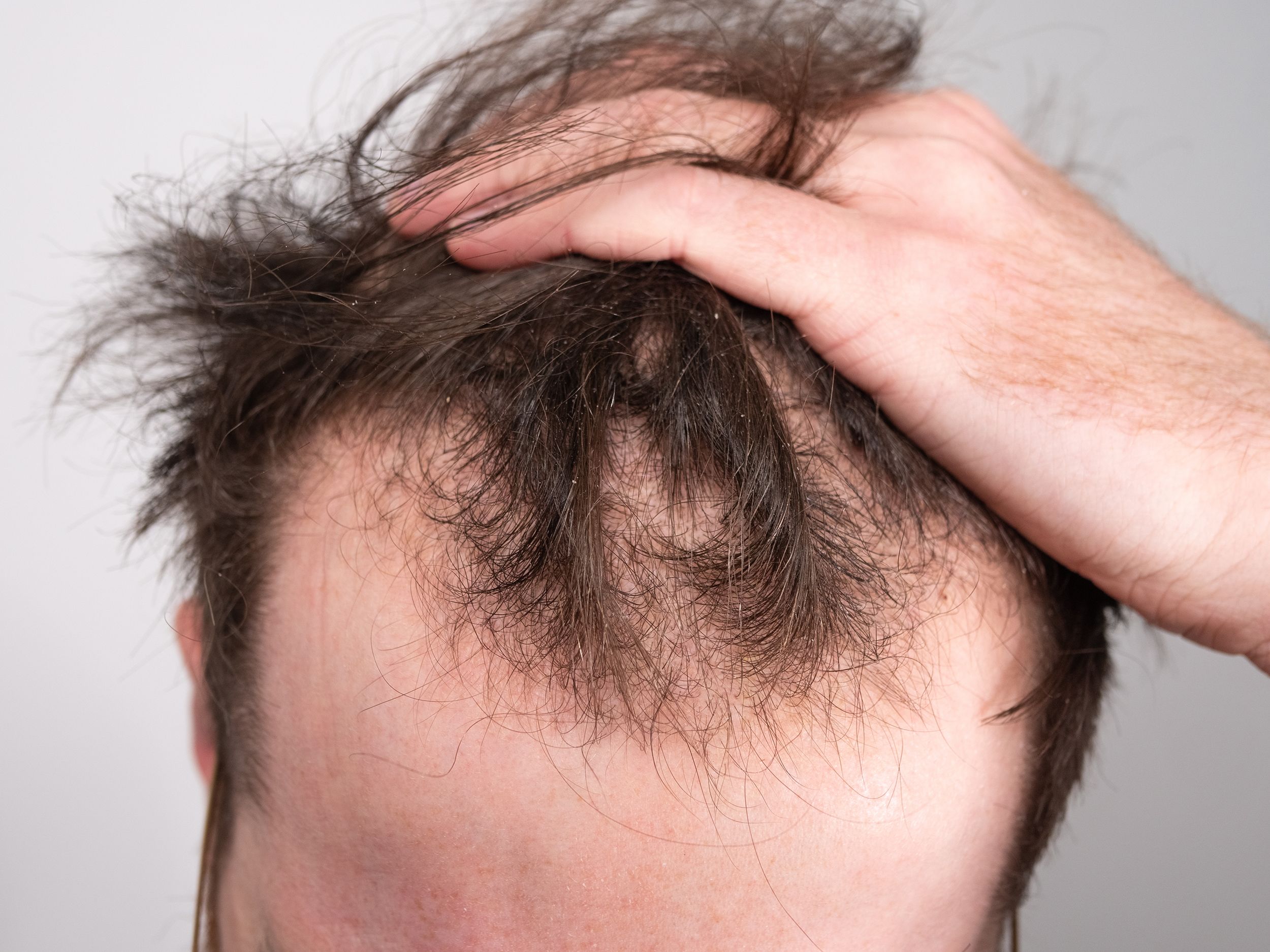 Finasteride 5mg sans ordonnance