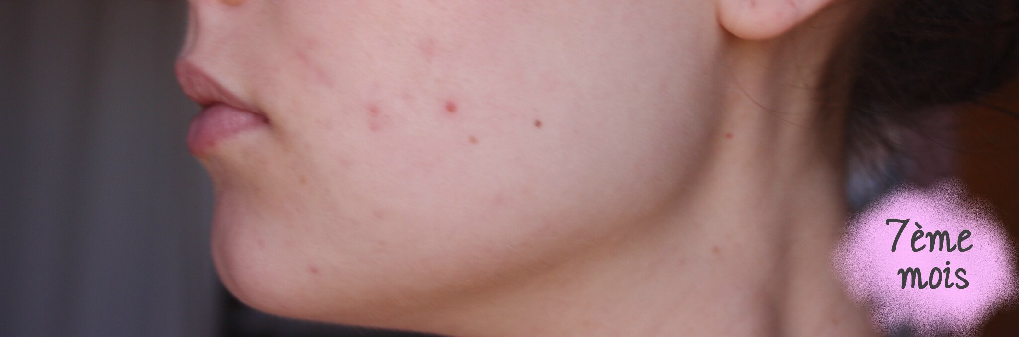 Roaccutane pas cher