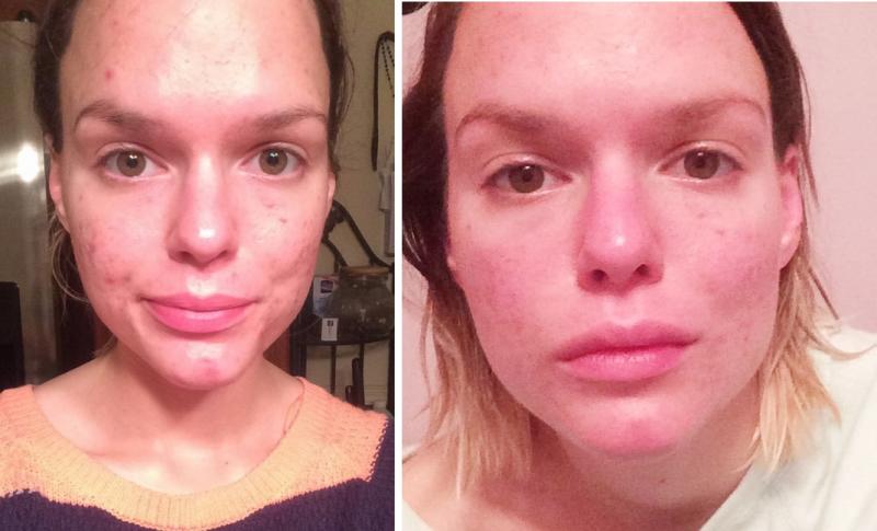 Accutane online eu