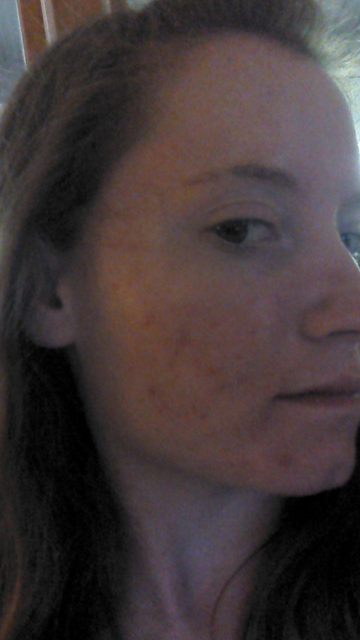 Accutane pas cher