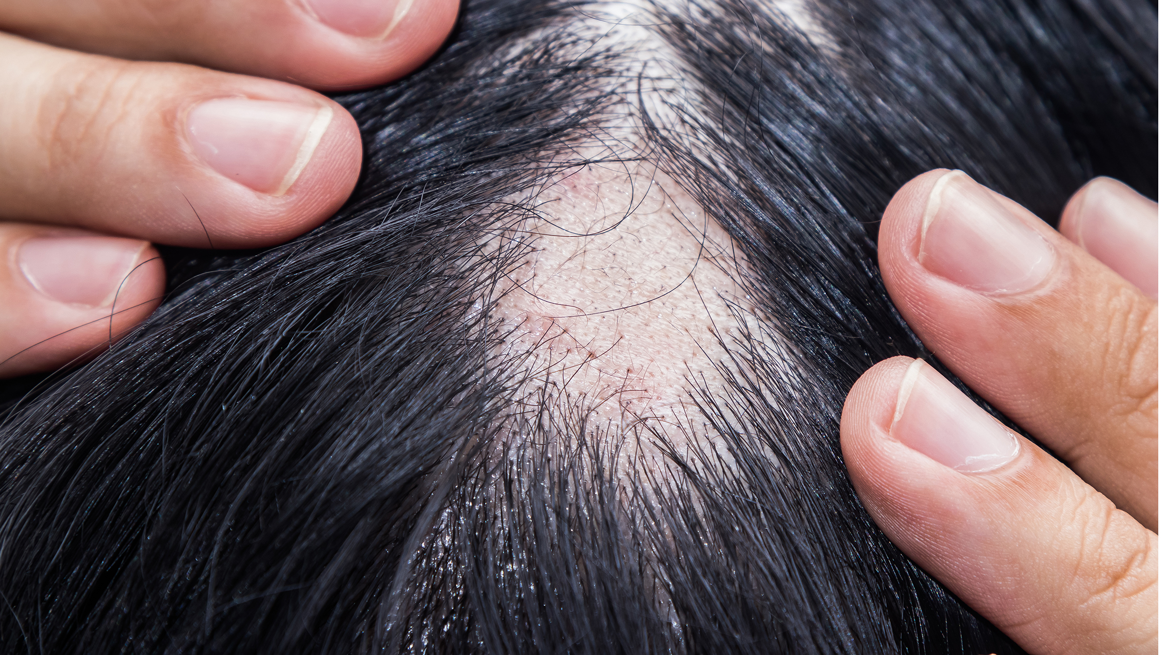 Finasteride 1 mg prix