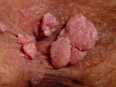Aldara medicament prix