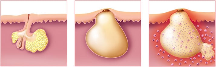 Isotrex gel prix