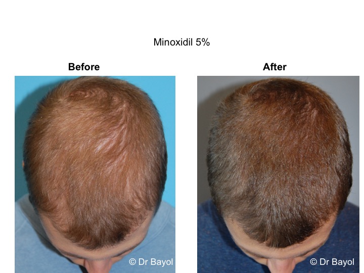 finasteride le moins cher