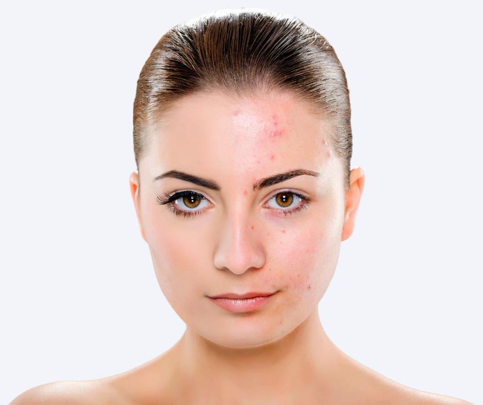 Coût du accutane