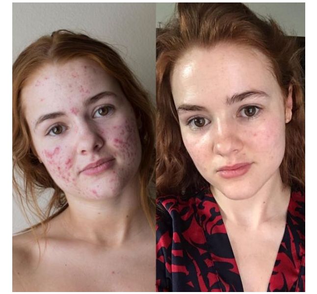 Roaccutane sans contraception