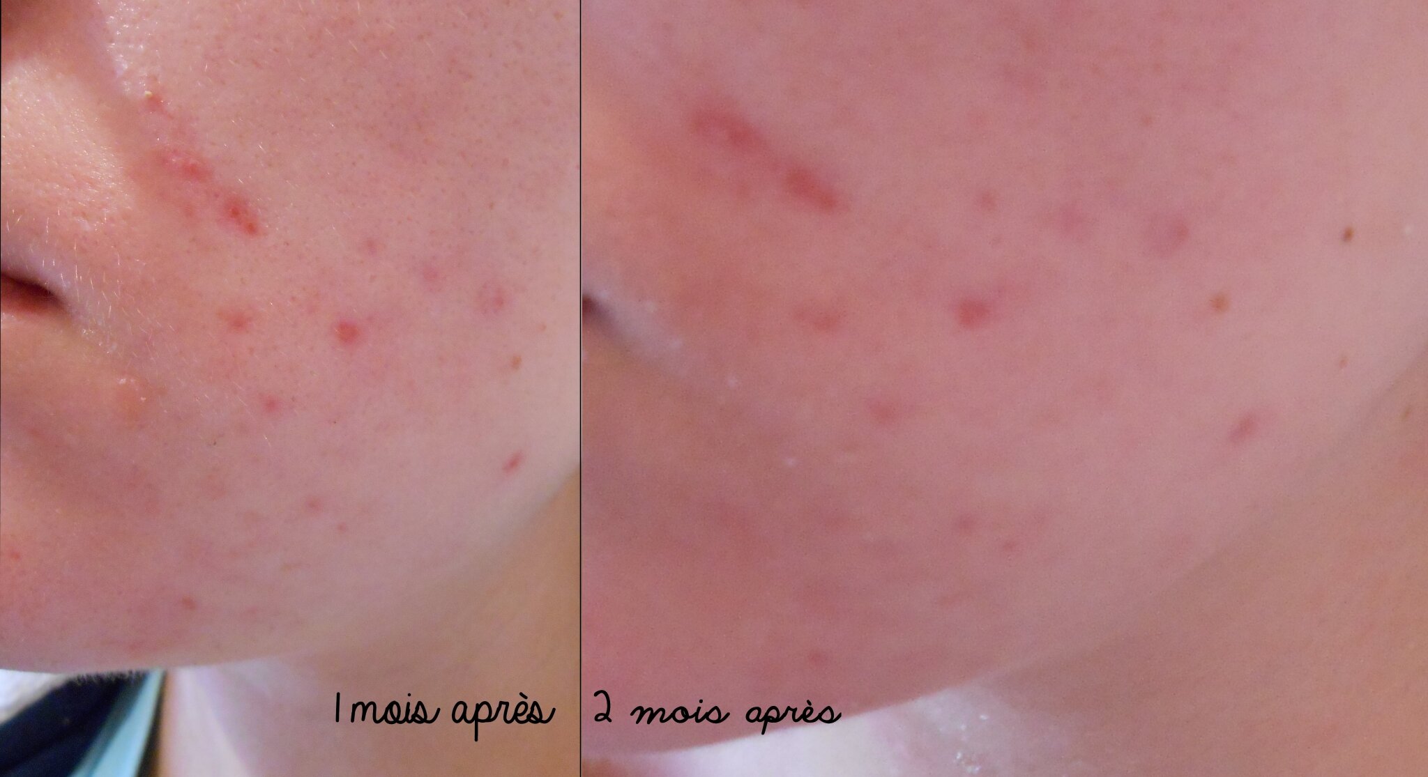 Roaccutane 20mg