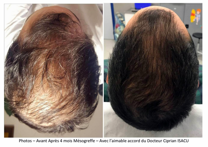 Finasteride moins cher