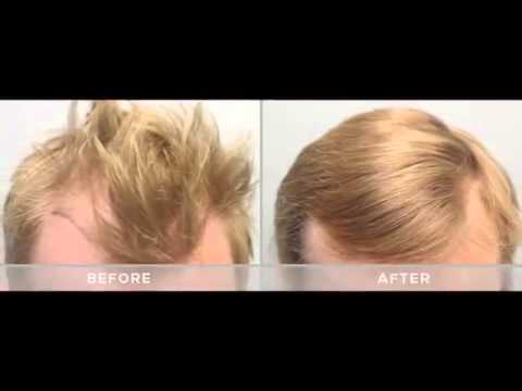 Où acheter du finasteride