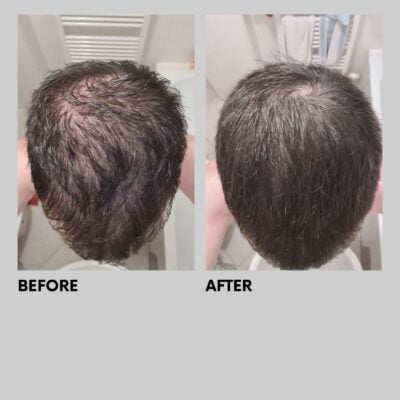 Finasteride acheter online