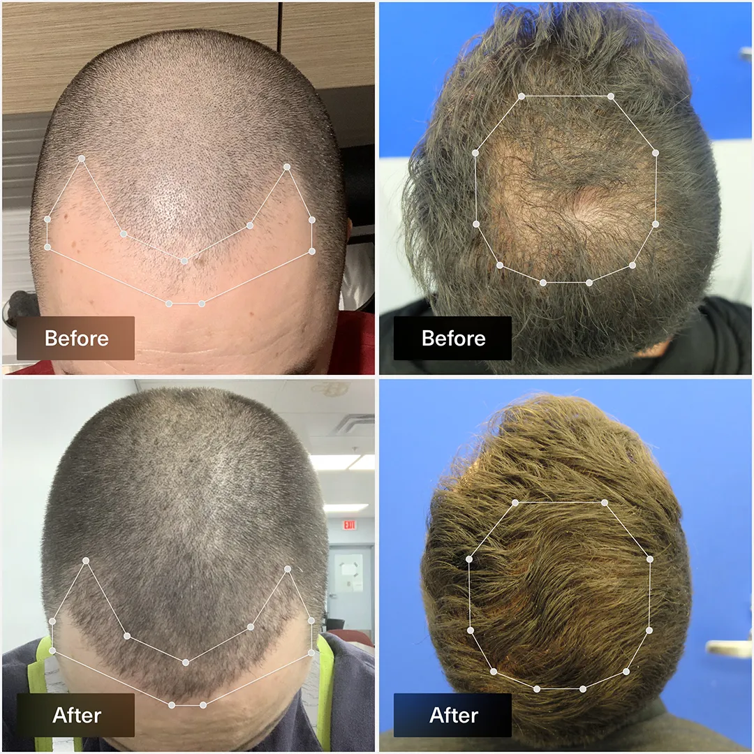 Finasteride en ligne