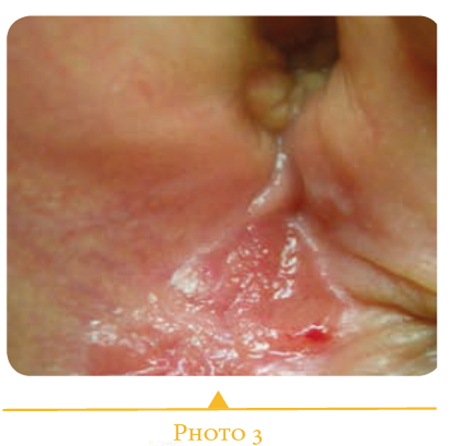 Imiquimod Pilule