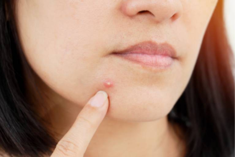 Isotretinoin Online Acheter