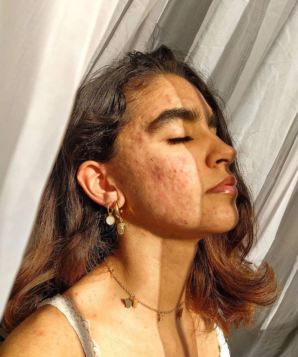 Pilule sous roaccutane