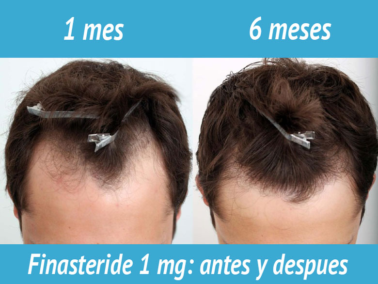 Propecia 1 mg farmacia online