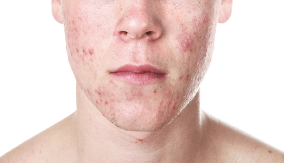 Roaccutane achat france