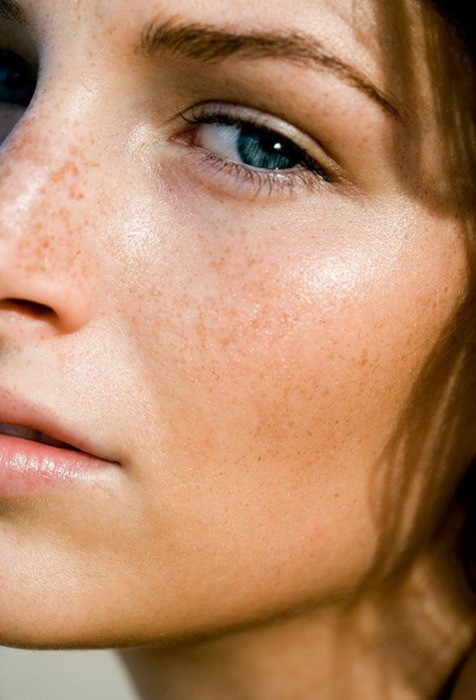 Roaccutane acné pilule