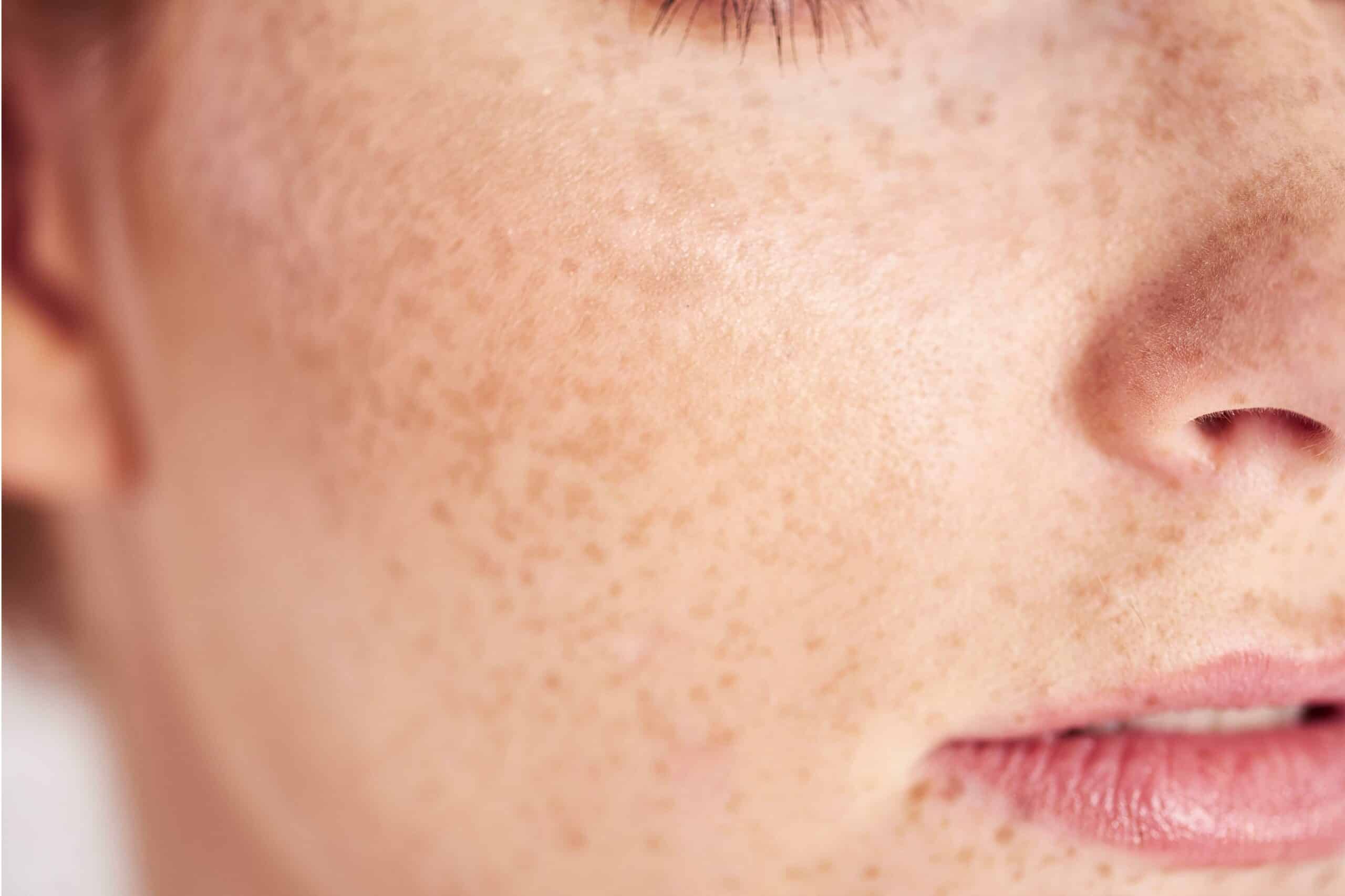 Roaccutane creme prix