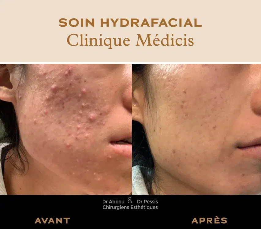Roaccutane France Prix