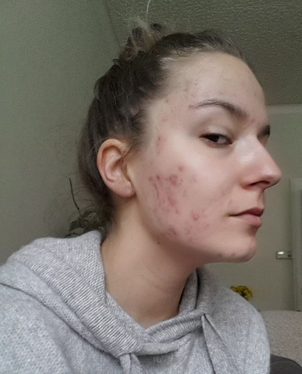 Roaccutane prix 2020